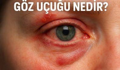Göz Uçuğu Nedir?